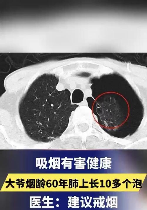 吸烟的代价（一个拥有美好未来的年轻人的悲惨命运）